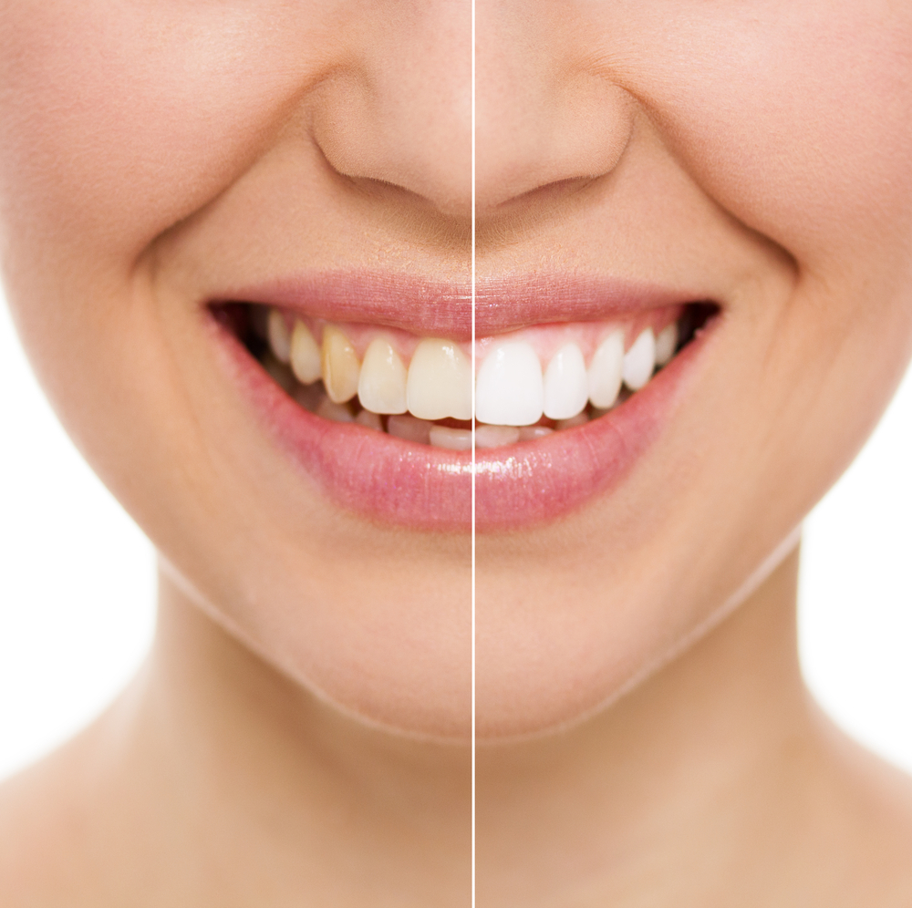smile-makeover